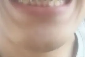 正畸前需要做哪些准备？图片