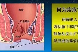 痔疮到底该不该做手术？做过的人会后悔吗？颠覆很多人想象图片