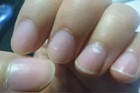 指甲上的白点、月牙、竖纹代表什么？有些问题，建议你别忽视图片