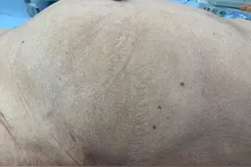 83岁老汉得了怪病，肚子胀得像孕妇，再不做手术，肚子要爆炸图片