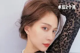 广州隆鼻案例｜普通女孩到又A又飒，她只是做了个肋骨鼻综合图片