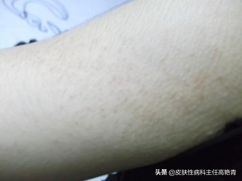 肚子毛周角化遇热变大