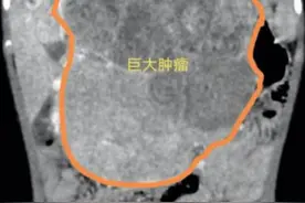 4岁娃肚子大如孕妇，一查竟然是恶性肿瘤图片