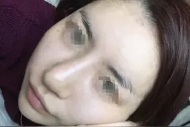 成功鼻修复，让我走出隆鼻失败的阴霾图片