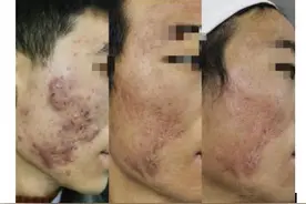 贵州毕节小伙美容院祛痘反变烂脸，广州帮扶医生拯救“月球脸”图片