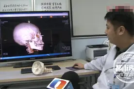 命大！钢筋穿透男孩眼眶直插入脑，医生妙手回春救下性命图片