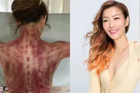 郑秀文晒背部刮痧画面惊人 自认刮痧是首选舒缓疲劳方式图片