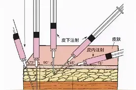 促排卵针该怎么打？图片