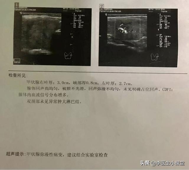 常见的桥本氏甲状腺炎，到底该不该治？能治好吗？