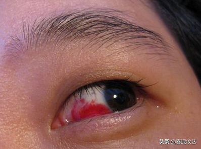 戴完美瞳眼睛红怎么办
