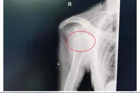 老人跌倒手掌撑地，致肩关节脱位！骨科医生一招即复位图片