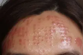 一次水光针=1000次面膜？她们打完不正规的水光针都很后悔图片