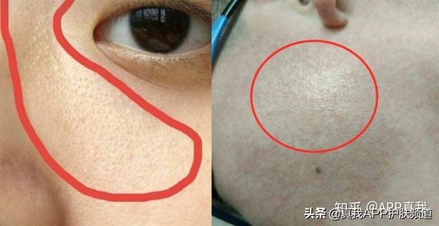 面颊表皮角化
