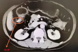 上腹疼痛近两年 以为自己是“胃病”结果：是鸡骨头扎穿了十二指肠图片