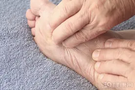 痛！脚上长鸡眼怎么办？要在脚上挖洞吗？别信偏方，靠谱方法在这图片