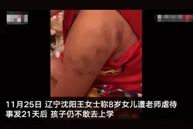 8岁小学生因不会做题被老师打致多处淤青 学校：涉事教师被处留校察看图片