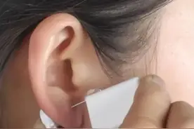 女大学生差点瘫痪，元凶竟是打耳洞图片