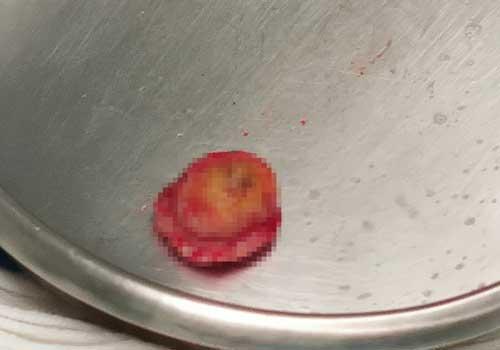 角化棘皮瘤可根冶吗