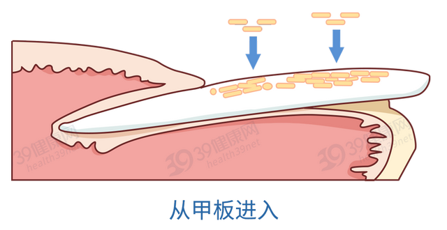 得了灰指甲，反复发作难根治？一次性介绍7种药，总有一款适合你