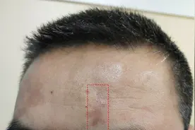 车祸疤痕应该怎么处理？图片