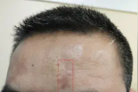 车祸疤痕应该怎么处理？图片