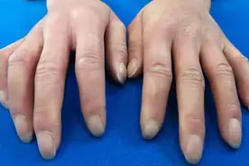 硬皮病一发现就是中晚期？如何早期识别系统性硬皮病？图片