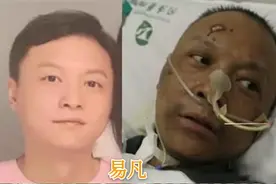 武汉两医生ECMO抢救后皮肤发黑，中医认为：不同脸色提示不同疾病图片