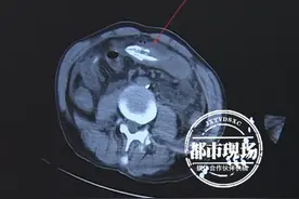 为治便秘 男子听信偏方 将活体黄鳝塞进肛门图片