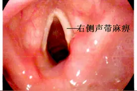 福建一女子声音嘶哑、喝水常被呛，一查发现了鸡蛋大肿瘤图片