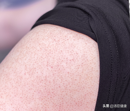 结婚时手臂鸡皮肤