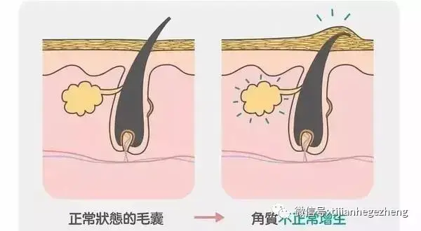 重症毛囊角化病