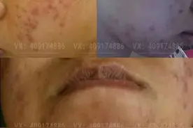拯救痘痘大作战：我的祛痘辛酸史！（文中图片可能引起你的不适）图片