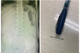 漳州909医院：后怕！两个孩童竟把这些东西吞进肚里图片