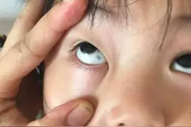 孩子眼白部分有“黑点”？大多有3个原因，早知道早预防图片