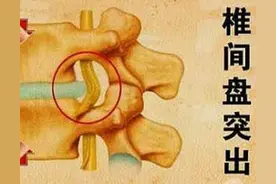 腰椎间盘突出症患者饮食注意图片