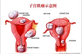 #健康科普汇#【子宫肌瘤患者的饮食注意事项——3】图片