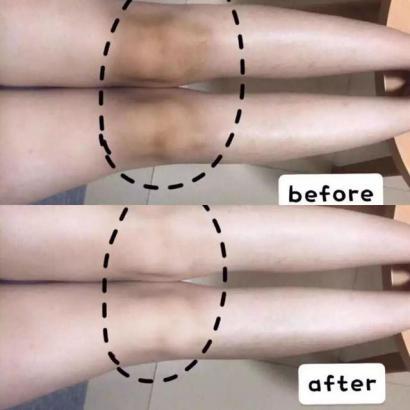 去粉刺毛囊炎痤疮鸡皮身体乳