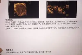 子宫内膜息肉是怎么回事？影响怀孕吗？专家这样说图片