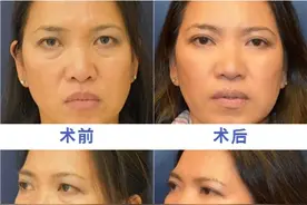 关于“祛眼袋手术”这件事，医生与你说句实话图片