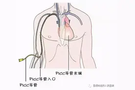 PICC置管术的护理，这些你都要了解图片