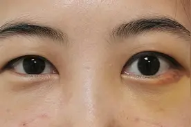整形医生不会说：做完眼袋手术后，容易出现的7种问题，建议收藏图片