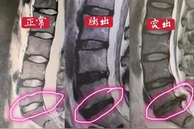 一文说清！腰椎间盘膨出、突出、脱出的区别，别再盲目开刀了图片