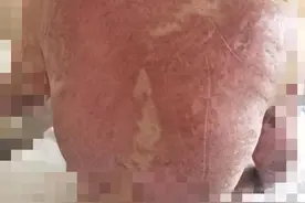 4次手术，130多次换药，三进三出ICU，我们终于把她救回来了图片