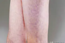 孩子腿上出现紫色的网状血管图案，提醒你可能患有败血症图片
