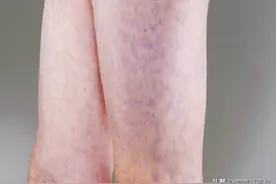 孩子腿上出现紫色的网状血管图案，提醒你可能患有败血症图片