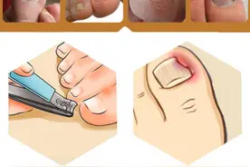 脚趾甲总往肉里长，得了“嵌甲”怎么办？医生：2个方法很管用图片