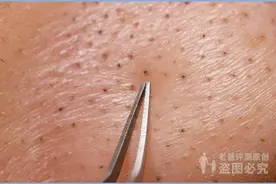 黑头究竟要怎么去？我们拔出并放大了四种类型的黑头图片