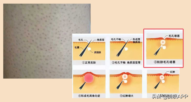 毛周角化会有黑点吗