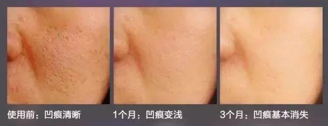 美肌冻干粉有什么作用 美肌冻干粉有什么作用和功效