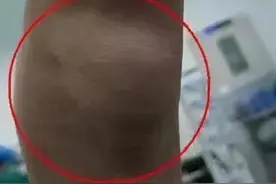 4个0.5cm微小切口的手术巧取膝关节腘窝囊肿图片